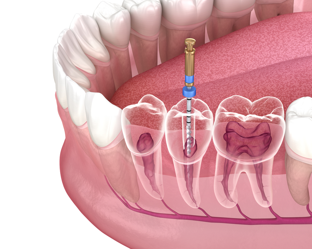 root canal